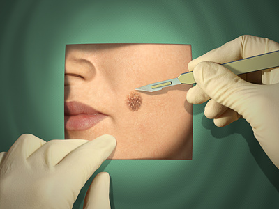 CO2 LASER FOR SKIN LESION REMOVAL