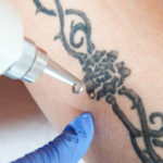 laserowe usuwanie tatuażu