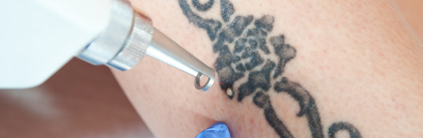 usuwanie tatuażu